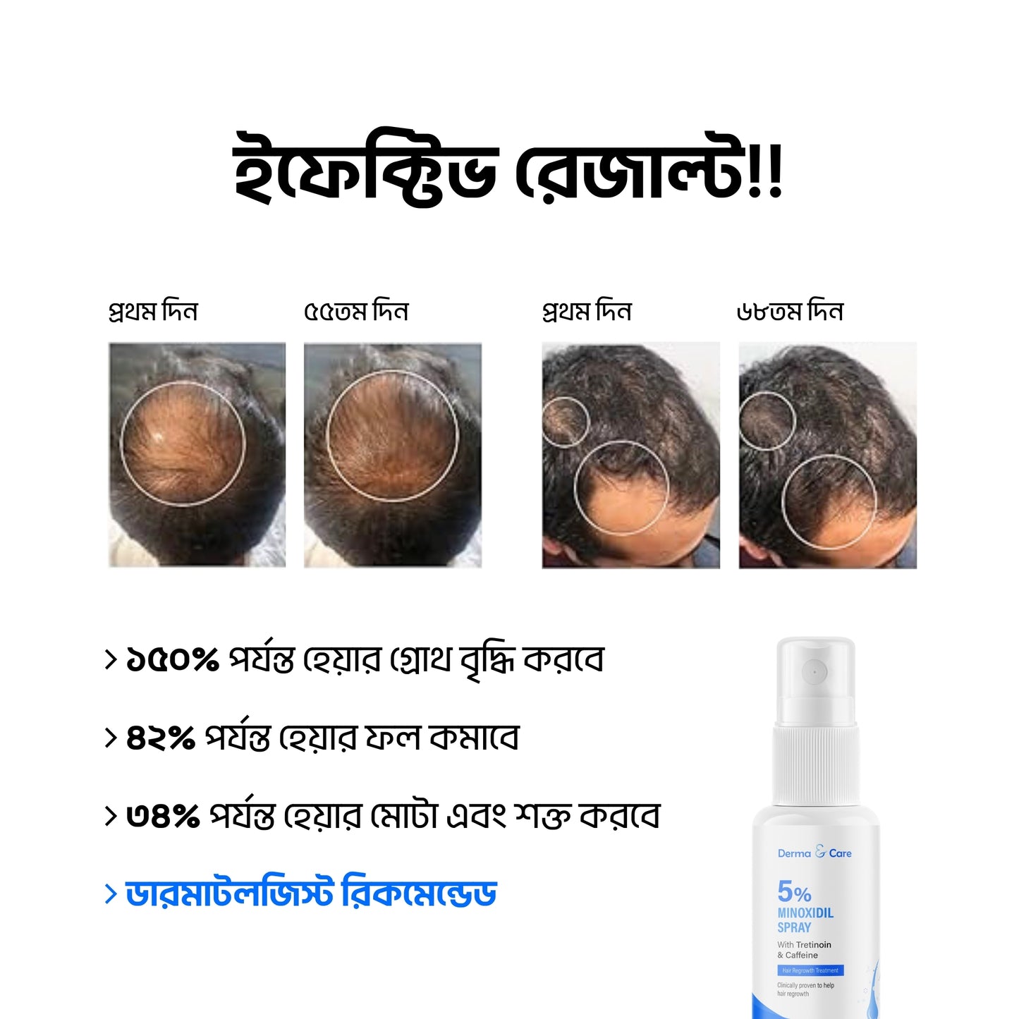5% Minoxidil with tretinoin & caffeine hair spray 60ml
