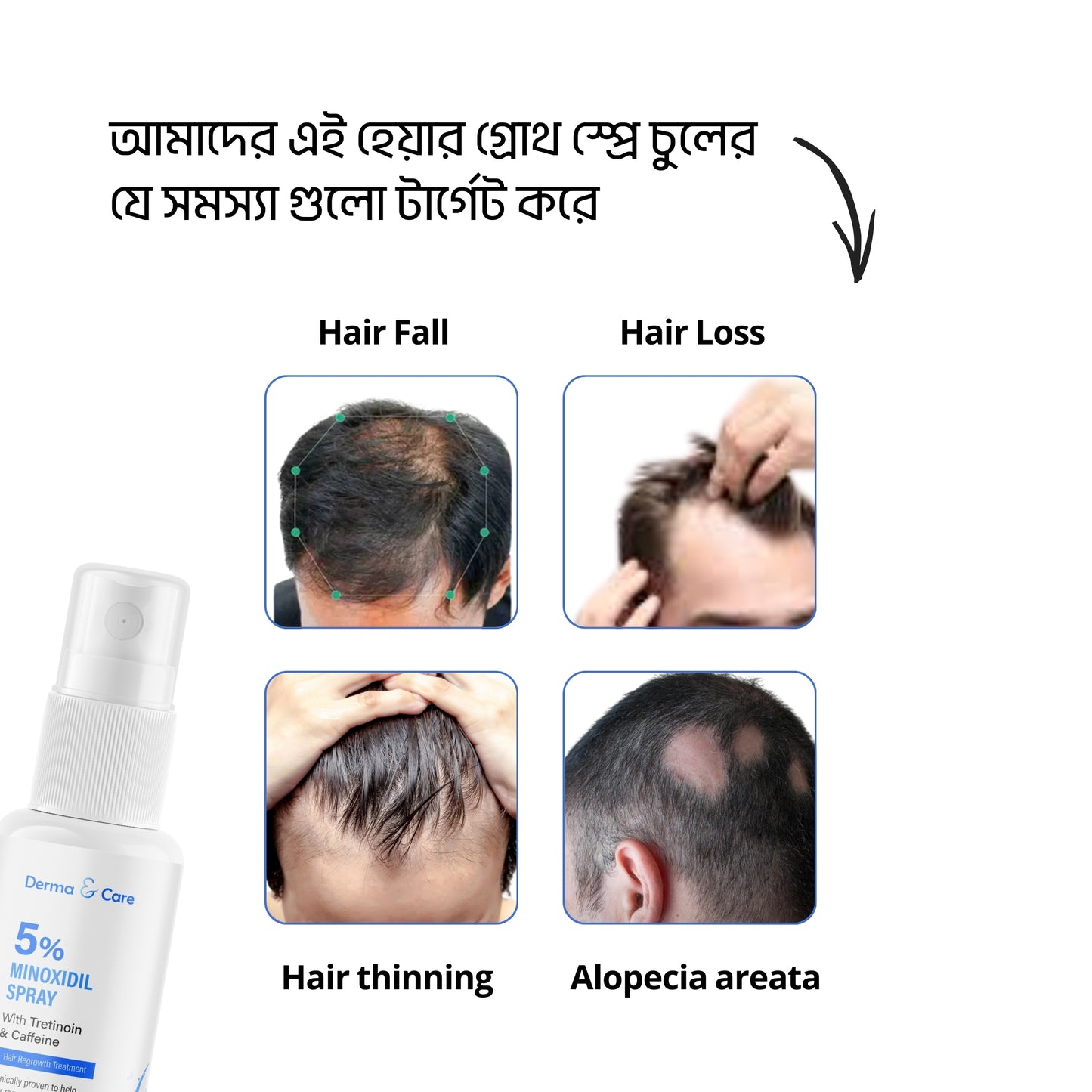 5% Minoxidil with tretinoin & caffeine hair spray 60ml